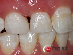 樹脂美學(xué)修復(fù)兩例 以最小創(chuàng)傷重塑自然之美